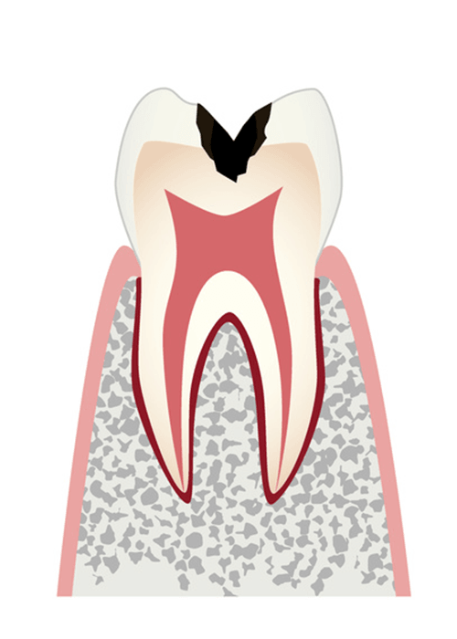 象牙質＝エナメル質のすぐ下にあり神経を守っている組織の虫歯